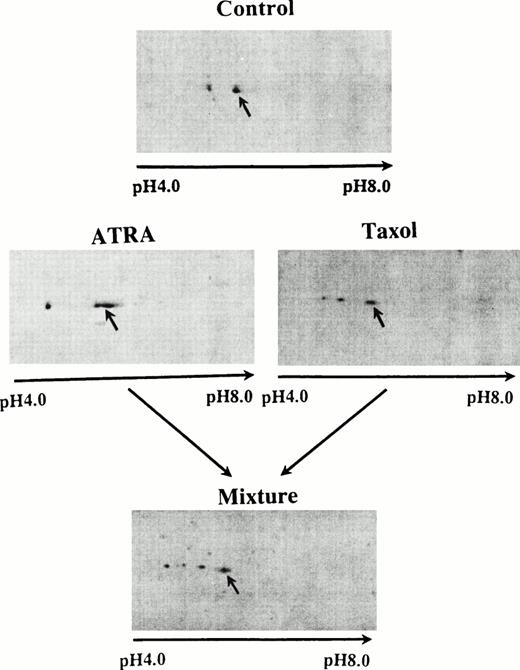 Fig. 3. 2D gels of lysates from blast cells from an AML patient. Control is seen at the top; the middle shows gels from cells treated with ATRA (left) and taxol (right). At the bottom is the 2D gel of a mixture of these two lysates. Similar results were obtained using the blast cells from a second patient.