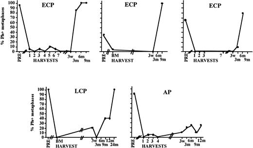 Fig. 6. Cytogenetic relapse observed early after transplantation even in patients in whom the inoculum was completely or almost completely Ph negative. Depicted is the posttransplantation cytogenetic analysis of the BM of five individual patients who received a Ph-negative inoculum.