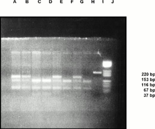 Fig. 1. Factor V gene mutations in Budd-Chiari cases.