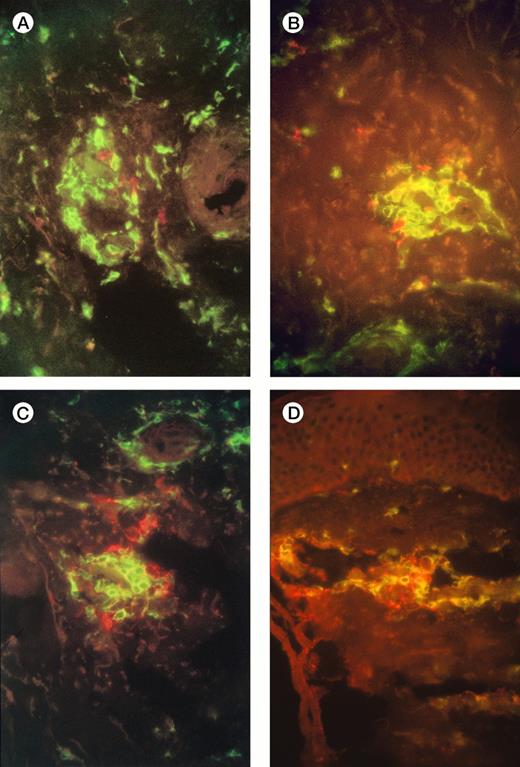Fig. 1. Immunofluorescence studies of frozen sections of tissue taken from the injection sites of patients 3 and 7 one week after injection of IL-2-transduced autologous tumor cells. The figures show a moderate infiltration with T cells (A), and scanty surviving neuroblasts (B). (A,B) Patient 3 (A) and 7 (B) CD4+ T cells are green, and CD8+ T cells red; there is a preponderance of CD4+ cells. (C,D) Patient 3 (C) and 7 (D) CD4+ T cells are green, GD2+neuroblasts are red.