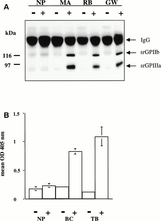 Fig. 6. (A) Reactions of drug-dependent antibodies MA, RB, and GW with srGPIIb-IIIa in the presence (+) and absence (−) of 0.4 mmol/L quinine (MA and RB) and quinidine (GW). All three drug-dependent antibodies precipitated bands corresponding to srGPIIb and srGPIIIa in the presence of drug only. No precipitation was seen with normal plasma (NP). (B) Reactions of sulfamethoxazole-dependent antibodies BC and TB with srGPIIb-IIIa in the presence (+) and absence (−) of 0.4 mmol/L sulfamethoxazole. IgG bound to srGPIIb-IIIa was detected by modified antigen capture ELISA. No reaction was obtained with normal plasma (NP).