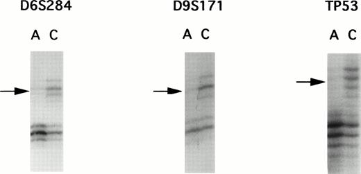 Fig. 1. Autoradiographs from LOH analysis with microsatellite markers. PCR products were separated by polyacrylamide gel electrophoresis, showing examples of allelic loss found in patient E. DNA samples isolated from leukemic cells in the acute phase are labelled as A and those DNA samples isolated from corresponding normal peripheral leukocytes after complete remission are designated as C. Microsatellite markers are indicated above the autoradiograms. Arrows, loss of one allele.