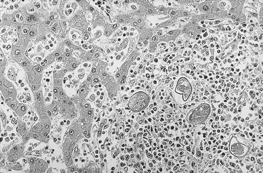 Fig. 1. A circumscribed egg granuloma of Schistosoma japonicum among the lymphoma cells in a portal area of the liver. Sinusoidal involvement of the lymphoma cells is also evident. Hematoxylin and eosin stain; original magnification ×200.