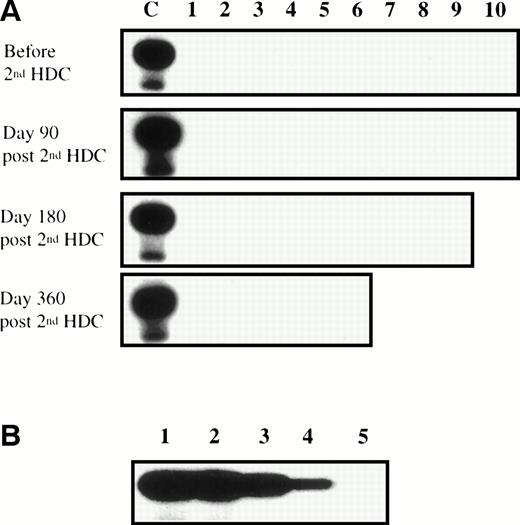Fig. 1. Lack of KSHV reactivation during treatment-induced immunosuppression in MM patients. (A) DNA samples extracted from BM before and 90, 180, and 360 days after second HDC were amplified by PCR using the KSHV 330233 primers. Each PCR was performed on 1 μg of genomic DNA and the amplification products were transferred to a nylon membrane and hybridized with a 32P end-labeled internal probe. The positive control (lane C) was the PCR product from the KSHV-infected BCBL-1 cell line. (B) Lanes 1 through 5 contain 10-fold dilutions of BCBL-1 DNA from 1 ng (lane 1) to 0.1 pg (lane 5). BCBL-1 DNA was diluted in the DNA extracted from heparinized BM mononuclear cells from patient no. 1 90 days after the second HDC, so that all PCR were run on 1 μg of total DNA. These data are representative of 10 experiments performed with the heparinized DNA samples extracted from the 10 patients 90 days after second HDC.