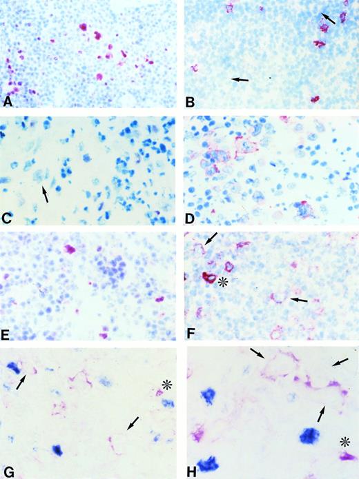 Fig. 1. (A and B) Frozen sections from nodular lymphocyte predominance HD stained with the BCL-6 MoAb (A) and the syn-1 MoAb (B). L&H cells show a strong nuclear positivity for BCL-6 (A), whereas no syn-1 expression is detectable (arrows). Residual plasma cells show cytoplasmic staining for syn-1 MoAb (B). (C and D) Frozen sections from classic (nodular sclerosis) HD stained with the BCL-6 MoAb (C) and the syn-1 MoAb (D). No BCL-6 expression is detectable; a BCL-6− RS cell is shown (arrow) (C). Conversely, several RS cells show cytoplasmic and membrane staining for syn-1 (D). (E and F) Serial frozen sections from a case of classic (nodular sclerosis) HD stained with the BCL-6 MoAb (E) and the syn-1 MoAb (F). Few RS cells show a nuclear positivity for BCL-6 (E), whereas the majority of RS cells express syn-1 (F); the intensity of staining of RS cells for syn-1 (arrows) is lower than that of reactive plasma cells in the background (asterisk). (G and H) Frozen sections from cases of classic (nodular sclerosis) HD tested by two-color staining with BCL-6 MoAb and syn-1 MoAb (see Materials and Methods). In both cases BCL-6+ (nuclear, blue) RS cells and syn-1+ (cytoplasmic and membranous, red) RS cells (arrows) are present. Note positive staining of bystander plasma cells (asterisks). No coexpression of BCL-6 protein is detectable in the syn-1+ RS cells. APAAP immunostaining, hematoxylin counterstain (A through F). Two-color staining, no counterstain (G and H). Original magnification × 180 (A and B), × 250 (C through G), × 400 (H).