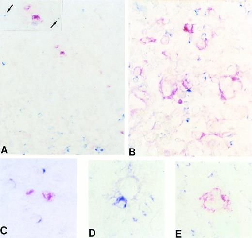 Fig. 2. (A through E) Frozen sections from a case of classic (nodular sclerosis) HD tested by two-color staining with CD40L and BCL-6 MoAbs (A, C, and D) and CD40L and syn-1 MoAbs (B and E) (see Materials and Methods). Only scattered CD40L+(cytoplasmic, blue) lymphoid cells are detectable in the proximity of BCL-6+ (nuclear, red) RS cells (A), whereas expression of CD40L (cytoplasmic, blue) can be observed on several reactive lymphocytes that surround syn-1+ (cytoplasmic and membranous, red) RS cells (B). (A, inset) A higher magnification of BCL-6+ RS cells with two CD40L+ lymphoid cells (arrows). (C through E) RS cells of classic HD displaying the BCL-6+ (C), BCL-6− (D), and syn-1+ (E) phenotype, respectively. The BCL-6+ RS cell does not display close association with CD40L+ T cells (C). Conversely, both BCL-6−(D) and syn-1+ (E) RS cells are accompanied by several CD40L+ T cells. Two-color staining, no counterstain. Original magnification × 180 (A), × 250 (inset A), × 400 (B), × 630 (C, D, and E).