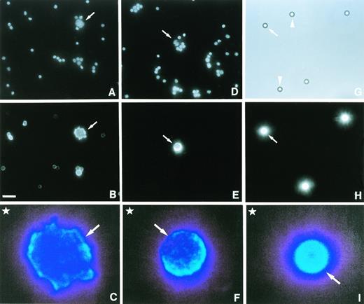 Fig. 2. Deficient MHC class II antigen presentation in a subset of HRS cells. Fresh lymph node tissue from a patient with nodular sclerosis Hodgkin's disease was disaggregated into a single-cell suspension and the viable cell fraction incubated for 90 minutes at 37°C with 5 μg/mL Hoechst 33258 (A and D) and stained with either an MHC class II αβ dimer-specific antibody (BU27) (B) or an antibody that recognizes CLIP bound to MHC class II molecules (CerCLIP.1) (E). Cell suspensions with surface-bound MoAbs or a mixture of synthetic beads with (G, H, I, arrows) or without (G, arrowheads) bound mouse IgG2a molecules (4.2 × 105 per bead) were fluorescently labeled with a PE-conjugated goat anti-mouse secondary antibody. Samples were processed for fluorescence microscopy and visualized by illumination with either ultraviolet (A, D), green (B, E, H), or white light (G). Enlarged images of labeled HRS cells (C, F, arrows) and synthetic beads (I, arrow) were used for densitometric analysis. Here, examples are shown in false colors to visualize the relative membrane densities of MHC class II molecules. A long wavelength (light blue) represents a high membrane density. Densities in the upper left-hand corner (C, F, I, stars) were used for background subtraction. Notice that a proportion of bystander lymphocytes express MHC class II αβ dimers (B) but not MHC class II αβ–CLIP complexes (E). Bar in (B) is 20 μm. Magnifications in (A, B, D, E, G, H) are the same.