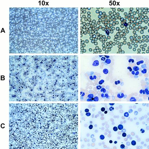 Fig. 8. Wright-stained peripheral blood smears from mice displaying an abnormal cell population and elevated leukocyte counts. (A) A normal untransplanted mouse blood smear at the indicated magnifications is shown in the top panel. (B) The middle panel shows the most common phenotype seen with MDR1 expanded cells, which includes a large number of cells with a granulocytic morphology. (C) In a few cases, a leukemic blast phenotype was seen (4 of 24 mice), indicating possible transformation from a myeloproliferative disorder into a less differentiated leukemia.