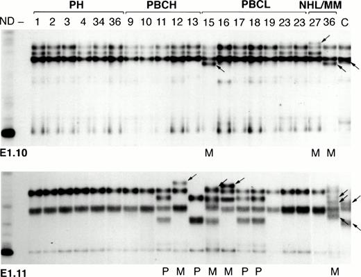 Fig. 1. SSCP analysis of representative first intron segments of the BCL-6 gene in PT-LPDs. Samples corresponding to radiolabeled, PCR-amplified fragments from the E1.10 (top) and E1.11 (bottom) regions of BCL-6 are shown. Numbers above the lanes indicate the corresponding cases. Among the patients with more than one PT-LPD lesion are Cases 23 and 36. The histological classification of each case is indicated above the corresponding lanes. Several identical bands were seen in all of the samples in the cases containing the wild-type sequence. Three different wild-type patterns are seen in the E1.11 region (bottom) due to a known polymorphism; polymorphic cases are indicated with a P beneath the corresponding lanes (Cases 11, 15, 17, and 18 are heterozygous and Case 13 is homozygous for this polymorphism). Cases 15, 27, and 36 showed a different pattern (arrows) in region E1.10 (top), and Cases 12, 15, 16, and 36 showed a different pattern (arrows) in region E1.11 (bottom), as a result of the presence of mutations in the corresponding region, indicated with an M beneath the corresponding lanes. ND, amplified DNA that was not denatured before electrophoresis; —, the same PCR reaction in the absence of DNA; C, positive control known to contain BCL-6 mutations in the region examined.