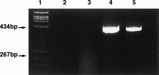 Fig. 1. Ethidium bromide-stained 4% polyacrylamide gel of IgH framework 1 PCR products obtained at diagnosis and relapse in patient 1. Lane 1, PBR 322/HaeIII size marker. Lane 2, water blank. Lane 3, normal bone marrow sample showing a typical polyclonal smear. Lane 4, patient 1 at diagnosis. Lane 5, patient 1 at relapse.