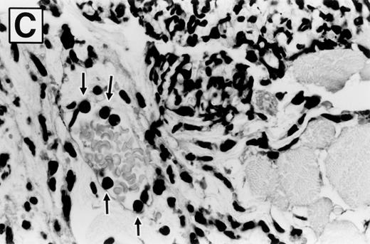 Fig. 5. Photomicrographs of zymosan-injected tissue in wild-type and E- and P-selectin–deficient mice. Ear tissue was removed 8 hours after zymosan injection and sections were stained with hematoxylin and eosin. (A) Wild-type mouse (original magnification × 400). Micro-abscess consisting of aggregates of zymosan (Z) surrounded and walled off by a rim of leukocytes (between arrowheads). The leukocytes are predominantly neutrophils, many of which have distorted morphology due to having phagocytized zymosan particles. Adjacent connective tissue also contains a neutrophilic infiltrate. (B) E- and P-selectin–deficient mouse (original magnification × 400). General features are similar to those described in (A). However, the overall intensity of the leukocyte infiltrate is markedly reduced in comparison with the wild-type mouse tissue. (C) Higher magnification of inset from (A) (original magnification × 1,000). Neutrophils (arrows) adherent to endothelial cells lining a venule in the vicinity of a micro-abscess.