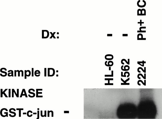 Fig. 7. JNK activity assay on lysates of cell lines and a leukemic blast crisis bone marrow sample from a patient with a transformed myeloproliferative disorder containing a Philadelphia chromosome. Both the human cell line model of acute leukemia formed in the presence of a Philadelphia chromosome (K562) and the primary patient sample containing Philadelphia chromosome show strong constitutive JNK activity. Another Ph+ acute leukemia (not shown) also demonstrated a similar level of activity.