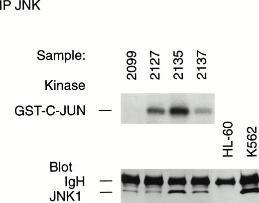 Fig. 9. Variations in JNK activity between different leukemia samples is not explained by the absolute level of cellular enzyme expression. Lysates from leukemic samples registering negative (nos. 2099, 2127, 2137) or positive (no. 2135) in the solid-phase JNK assay were immunoprecipitated and immunoblotted to show the presence of JNK protein in the lysates. Half of each immunoprecipitate was placed in an immune complex kinase JNK assay. Note the inactivity of immunoprecipitated JNK1 within no. 2099, despite the presence of a similar protein amount as no. 2127. Also note the apparent absence of immunoprecipitable JNK in the HL-60 cell line.