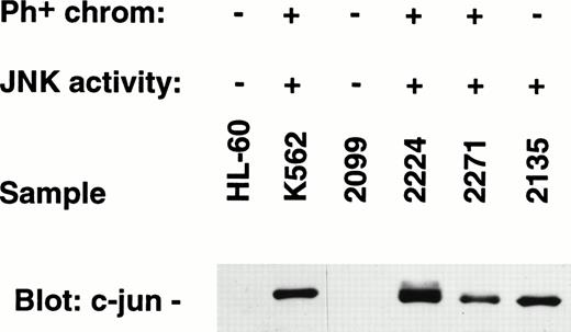 Fig. 10. Western blots prepared from SDS-PAGE electrophoresis of primary leukemia cell sample extracts were blotted for expression of c-jun protein. c-jun protein was shown in samples known to possess constitutive JNK enzyme activity.