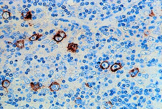 Fig. 2. Immunohistochemical demonstration of LMP2 expression by HRS cells in a case of EBV-positive HD.