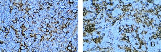 Fig. 3. Immunohistochemistry for MHC class I expression. Long black arrows show class I expression on HRS cells (A) or its absence (B). The intensity of class I staining on surrounding small reactive cells (short red arrows) is less than that of the HRS cells in (A) and greater than that of the HRS cells in (B).