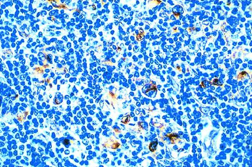 Fig. 4. Immunohistochemistry for TAP-1 in HD by HRS cells.