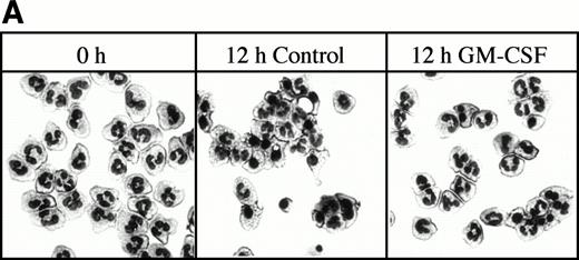 Fig. 1. Morphological assessment of neutrophil apoptosis after 12-hour culture. (A) shows cytospins, prepared as described in Materials and Methods. Nonapoptotic neutrophils with multilobed nuclei are clearly distinguishable from apoptotic neutrophils which have smaller, denser nuclei and decreased cell volume. (B) shows summary data of apoptosis by morphology, and the effects of various agents added to neutrophil suspensions, as described in Materials and Methods. * Indicates values that are significantly different from controls (P = .01) after at least three separate experiments.