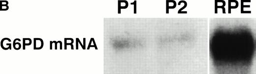 Fig. 1. (A) Expression of the P falciparum G6PD gene in parasites grown in normal and deficient E. Total P falciparumRNA (strain HB3B) was analyzed by Northern blot using K2O2 as a probe (see Materials and Methods). Approximately 4 μg of total RNA extracted from parasites grown in normal (N) and deficient (D) E at ring (RPE) and trophozoite (TPE) stage of the first growth cycle. Illustrative lanes are labeled at the top with the respective G6PD status. (B) Expression of the P falciparum G6PD gene in peripheral blood of patients infected with P falciparummalaria. Total RNA was extracted from the peripheral blood of two P falciparum–infected G6PD normal patients and analyzed as indicated above. Patient 1: Total RNA extracted from 2 mL of peripheral blood from a patient with a parasitemia of 0.25% RPE, corresponding to approximately 1.8 × 107 parasitized E. Patient 2: Total RNA extracted from 3 mL of peripheral blood from a patient with a parasitemia of 0.6% RPE, corresponding to approximately 8 × 107 parasitized E. RPE: 4.5 μg of total RNA extracted from in vitro culture (ring stage) of strain C1O.