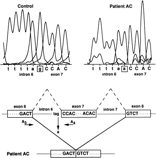Fig. 4. RH50 gene analysis in patient AC. The G residue at the 3′ acceptor splice-site of intron 6 is mutated to A in patient AC, thus resulting in the skipping of exon 7. Normal splicings of introns 6 and 7 are indicated by the broken lines. The approximate position of primers A3 and A4, used to amplify intron 6, is indicated. Intron and exon sequences are in lowercase and uppercase, respectively.