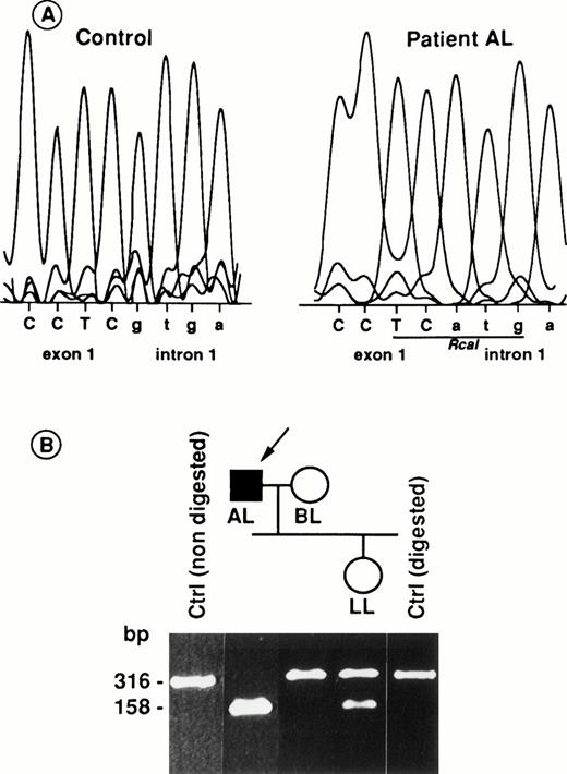 Fig. 5. Mutation of the RH50 gene in patient AL and its inheritance in the family. (A) The G nucleotide of the 5′ donor splice-site of intron 1 in the control sequence is replaced by an A in AL, thus creating a new Rca I site. (B) Tree of family L andRca I restriction pattern of the genomic PCR products are shown. The 316-bp PCR product (see Materials and Methods) encompassing the splice-site mutation shown in (A) was cleaved into two 158-bp fragments in AL, demonstrating the homozygosity of the mutation in this patient. As expected, the product from a control DNA was uncut. The arrow shows the Rhnull proposita AL. The initials of each family member are indicated. Intron and exon sequences are in lowercase and uppercase, respectively.