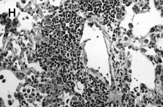 Fig. 1. Allogeneic transplant recipients with GVHD showed increased pathology. Photomicrographs of lung sections stained with hematoxylin and eosin show evidence of increased pathology in infected allogeneic GVHD mice. (A) Normal CBA, mock-infected, original magnification × 25; (B) normal CBA, mock-infected, original magnification × 100; (C) normal CBA, infected, original magnification × 40; (D) normal CBA, infected, original magnification × 100; (E) allogeneic GVHD, mock-infected, original magnification × 10; (F) allogeneic GVHD, mock-infected, original magnification × 75; (G) allogeneic GVHD, infected, original magnification × 10; (H) allogeneic GVHD, infected, original magnification × 100.