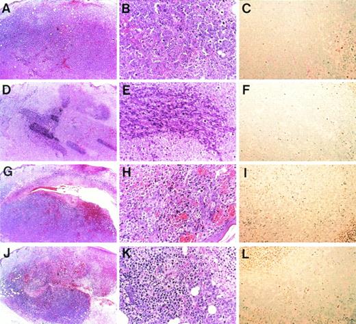 Fig. 7. Microscopic morphology of progressive and regressing subcutaneous K562 tumors. Balb/c nu/nu mice were injected subcutaneously with K562 cells and were subsequently injected with saline (A through C), monocyte-derived IL-8 (D through F), endothelial IL-8 (G through I), and TNF- (J through L). Tumors were removed in toto, and hematoxylin and eosin staining (A, B, D, E, G, H, J, and K) or TUNEL assay (C, F, I, and L) was performed after 8 days. Original magnification × 5 for (A), (D), (G), and (J); × 20 for (B), (C), (E), (F), (H), (I), and (K).
