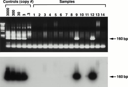 Fig. 2. Ethidium bromide staining (upper panel) and Southern hybridization (lower panel) of a representative PCR using the nested orf 26 (KS330) primer set. The sensitivity curve (consisting of a known copy number of HHV-8 from BCP-1 inoculated into 2 μg of Jurkat cell DNA) shows the limit of detection to be 3 genome copies per reaction by the presence of bands at the predicted 160-bp position (arrow) by both ethidium staining and Southern hybridization. Numbers 1 through 14 represent patient samples and show scattered positives.