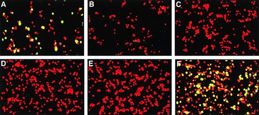 Fig. 3. Representative serum indirect immunofluorescence assay. Sera were tested in a 1:20 dilution by incubation on an HHV-8–containing cell line (KS-1); approximately 30% of the KS-1 cells express HHV-8 proteins, whereas the remainder act as internal controls. (A) represents a positive control, (B) a negative control, (C and D) two MM patients, (E) a breast cancer patient, and (F) an AIDS patient with KS. Positivity, green fluorescence restricted to approximately 30% of the cells is seen in the positive control and the AIDS patient only.