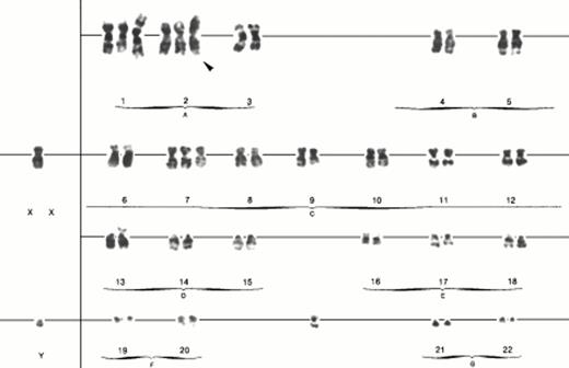 Fig. 2. Karyotype of case no. 3. Arrowhead indicates the i(2)(q10) chromosome.