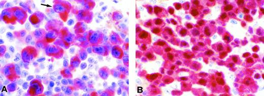 Fig. 1. Examples of anti-ALK immunostaining. (A) Large anaplastic cells from case no. 1 with the inv(2)(p23q35) showing strong diffuse ALK positivity confined to the cytoplasm. (B) In comparison, a case of CD30+ ALCL with the t(2;5)(p23;q35) showing expression of the NPM-ALK protein both in the cytoplasm and the nucleus is shown (A and B: lymph node formalin-fixed paraffin sections immunostained with the ALKc monoclonal antibody; APAAP technique; original magnification ×800).