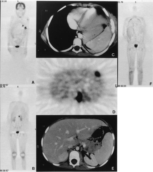 Fig. 1. (A and B) Coronal emission FDG-PET scan before BMT. PET shows multiple inflammatory lesions in the lungs and an inflammatory focus in the upper left psoas with an intense FDG uptake. Physiologic high FDG uptake is seen in the brain, kidneys, and bladder. (C, D, and E) Axial transmission corrected FDG-PET image and corresponding CT images. Both PET and CT show inflammatory lesions in the left lung invading a rib and in the left psoas. (F) Coronal emission FDG-PET scan 3 months after BMT. Hypermetabolic lesions have disappeared.