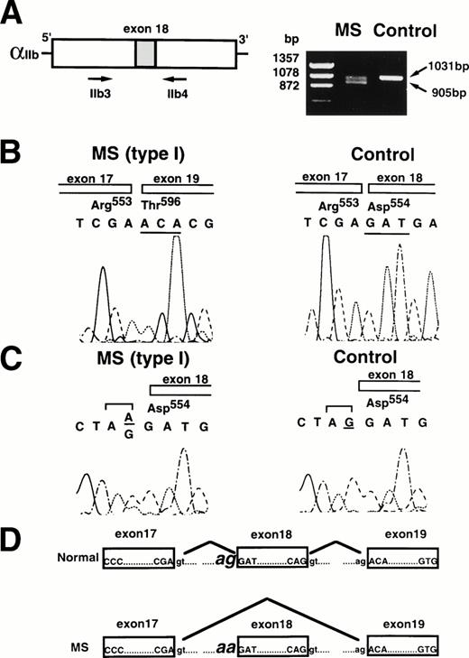 Fig. 3. Analysis of IIb cDNA and the IIb gene in patient MS. (A) Amplification of IIb cDNA from patient MS by RT-PCR. Two hundred fifty nanograms of total cellular RNA from MS or a normal control was amplified by RT-PCR using primers IIb3 and IIb4. The PCR products were electrophoresed on 1.5% agarose gel. (B) Nucleotide sequence analysis of IIb cDNA from patient MS. The cDNA PCR fragments were subcloned into pUC19, and nucleotides were sequenced. (C) Nucleotide sequence analysis of the IIb gene from patient MS. Nucleotide of the IIb gene from patient MS or a normal control was amplified by PCR using primers IIbE16 and IIbI18 and sequenced. (D) Schematic diagram indicates the mechanism of exon18 skipping of the platelet IIb mRNA.