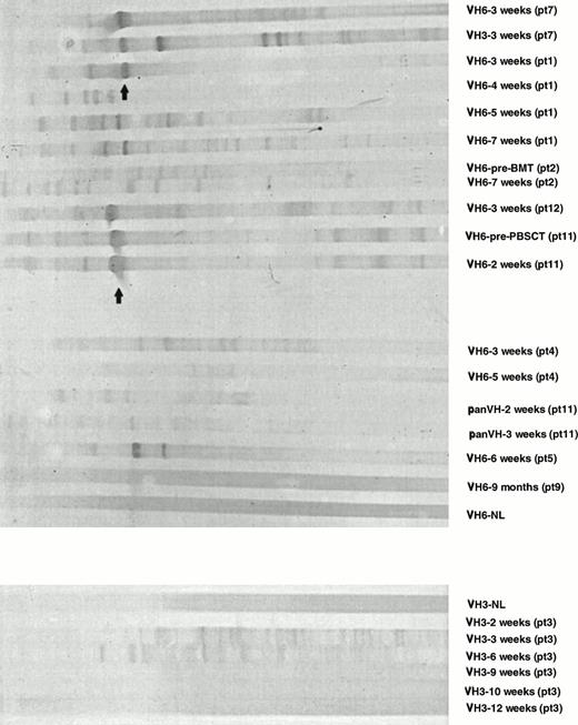 Fig. 3. Analysis of IgM H CDR3s posttransplant by SSCP. IgM panVH, VH3, and VH6 H CDR3s were amplified in nested PCRs as described in Materials and Methods. Two times the amount of PCR product used in fingerprinting experiments was loaded on to 5% polyacrylamide gels containing 5% glycerol. Gels were run at room temperature for 7 hours while being cooled by an electrical fan. Images were obtained by silver staining. In SSCP, CDR3s of the same basepair size can be separated due to differences in their mobility based on their tertiary structures. NL, normal donor. Pt, patient. Patient numbers are according to Table 1. Patient no. 12, who died of refractory NHL 2 months after an autologous PBSCT, was not included in other analyses. Bands indicated by the arrows represent renatured DNA determined by the simultaneously run control samples that were not denatured before loading (data not shown).