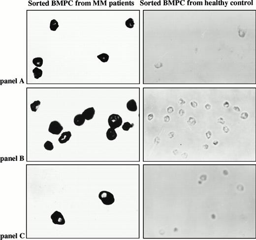 Fig. 2. In situ RT-PCR on BM plasma cells with patient-specific primers. (A) Plasma cells sorted from a BM of MM patient 10 and a healthy donor underwent in situ amplification with patient 10 CDR2/CDR3-IgH–specific primers. (B) Plasma cells sorted from a BM of MM patient 2 and a healthy donor underwent in situ amplification with patient 2 CDR2/CDR3-IgH–specific primers. (C) Plasma cells sorted from a BM of MM patient 11 and a healthy donor underwent in situ amplification with patient 11 CDR2/CDR3-IgH–specific primers.