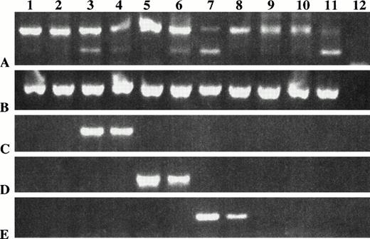 Fig. 3. RT-PCR with patient-specific primers detects clonotypic transcripts from both blood and BM of the relevant patient but not from unrelated patients or healthy donors. One microgram of total RNA isolated from myeloma and control BM and PBMC was reverse transcribed and amplified with patient-specific primers. A clonal product was detected only in BM and PBMC of the patient for whom the primers were generated. The following primer pairs were used in PCR: (A) consensus IgH VDJ, (B) histone (housekeeping gene), (C) primers for CDR2/CDR3 of patient 10, (D) primers for CDR2/CDR3 of patient 11, (E) primers for CDR2/CDR3 of patient 12. Lanes 1 and 2, unrelated myeloma patient; lane 3 patient 10 BM; lane 4, patient 10 PBMC; lane 5, patient 11 BM; lane 6, patient 11 PBMC; lane 7, patient #12 BM; lane 8, patient 12 PBMC; lanes 9 and 10 healthy control BM; lane 11 healthy control PBMC; lane 12 water control.