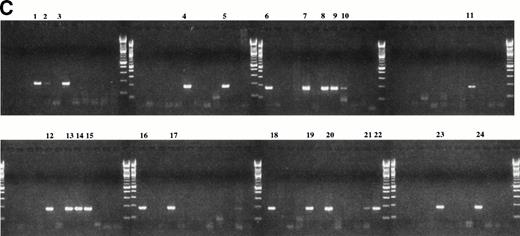 Fig. 4. Limiting dilution analysis of freshly isolated PBMC from patient 1 and 19 using PSA. (A) Limiting dilution assay of PBMC from patient 1. The number of cells indicated in the figure were added to PCR tubes, reverse transcribed, and amplified in PSA with patient-specific primers. The transcripts in each tube were amplified in nested PCR using consensus primers to FR2 and Jh1 followed by a second amplification using patient-specific CDR2 and CDR3 primers. Of three tubes containing one cell, one was positive and two were negative suggesting an approximate concentration of the clonotypic cells in the blood of about 33%. The number of B cells as measured by flow cytometry for an aliquot of the same PBMC sample was 35%. This PBMC sample is the same as that described in Table 3, line 2, where clonotypic cells represented 18% of PBMC as measured by in situ RT-PCR on sorted B cells. (B) Limiting dilution of fresh PBMC from patient 19. IgH transcripts were amplified using VH3 family specific,40and Jh consensus primers, followed by patient-specific CDR2 and CDR3 primers in nested PCR. For this patient, 2 of 3 tubes were positive at the concentration of three cells per well (with 37% negative tubes at this concentration, the approximate frequency of clonotypic cells is one in every three PBMC, based on Poisson statistics), and 2 of 3 positive at one cell per well. By flow cytometry, patient 19 had 34% B cells in the PBMC samples used for the limiting dilution assay. (C) Clonotypic IgH transcripts at one cell per tube from patient 19. To more accurately determine the number of clonotypic cells, 96 tubes of one cell/tube were analyzed and 24 were positive (25%), as shown in the figure. With 75% negative tubes at this concentration, the chances of a given tube receiving more than one clonotypic cell are very low.