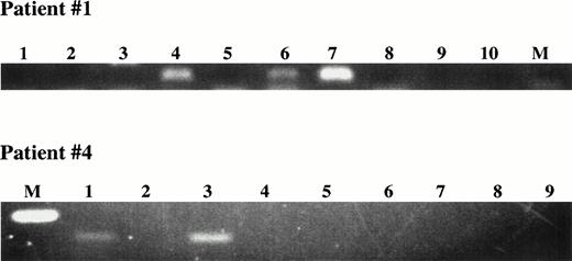 Fig. 5. Detection of circulating clonotypic cells among sorted PBMC B cells using single-cell in situ RT-PCR with patient-specific primers. (A) Single-cell RT-PCR using sorted B cells. Individual FMC63+ B cells were sorted directly into PCR tubes. Nested PCR first with consensus, and second with patient-specific primers was performed. The products had the expected size of 111 bp (Patient 1) or 160 bp (patient 4). M = molecular weight markers; Lanes 1 to 8 = sorted B cells; lanes 9,10 water controls. (B) In situ RT-PCR using sorted B cells. Row 1, CD19+ cells sorted from a peripheral blood of MM patient 11 and from a healthy donor underwent in situ RT-PCR amplification with patient 11 CDR2/CDR3-IgH–specific primers. Row 2, CD19+cells sorted from a peripheral blood of MM patient 12 and from a healthy donor underwent in situ amplification with CDR2/CDR3-IgH–specific primers for patient #12. Row 3, CD19+ cells sorted from a peripheral blood of MM patient 1 and from a healthy donor underwent in situ amplification with CDR2/CDR3-IgH–specific primers for patient 1. Row 4, CD19+ cells sorted from a peripheral blood of MM patient 5 and from a healthy donor underwent in situ amplification with CDR2/CDR3-IgH–specific primers for patient 5.