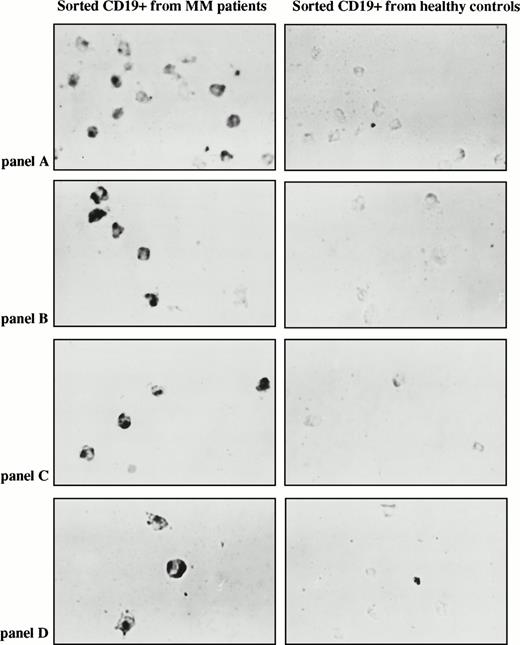 Fig. 5. Detection of circulating clonotypic cells among sorted PBMC B cells using single-cell in situ RT-PCR with patient-specific primers. (A) Single-cell RT-PCR using sorted B cells. Individual FMC63+ B cells were sorted directly into PCR tubes. Nested PCR first with consensus, and second with patient-specific primers was performed. The products had the expected size of 111 bp (Patient 1) or 160 bp (patient 4). M = molecular weight markers; Lanes 1 to 8 = sorted B cells; lanes 9,10 water controls. (B) In situ RT-PCR using sorted B cells. Row 1, CD19+ cells sorted from a peripheral blood of MM patient 11 and from a healthy donor underwent in situ RT-PCR amplification with patient 11 CDR2/CDR3-IgH–specific primers. Row 2, CD19+cells sorted from a peripheral blood of MM patient 12 and from a healthy donor underwent in situ amplification with CDR2/CDR3-IgH–specific primers for patient #12. Row 3, CD19+ cells sorted from a peripheral blood of MM patient 1 and from a healthy donor underwent in situ amplification with CDR2/CDR3-IgH–specific primers for patient 1. Row 4, CD19+ cells sorted from a peripheral blood of MM patient 5 and from a healthy donor underwent in situ amplification with CDR2/CDR3-IgH–specific primers for patient 5.