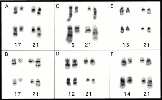 Fig. 2. Partial karyotypes from patients with rearrangements ofCBFA2. (A) Patient no. 1, t(17;21)(q11.2;q22); (B) patient no. 4, t(17;21)(q11.2;q22); (C) patient no. 2, t(5;21)(q13;q22); (D) patient no. 3, t(12;21)(q24;q22); (E) patient no. 5, t(15;21)(q22;q22); and (F) patient no. 6, t(14;21)(q22;q22). The abnormal homolog is on the right in every example.