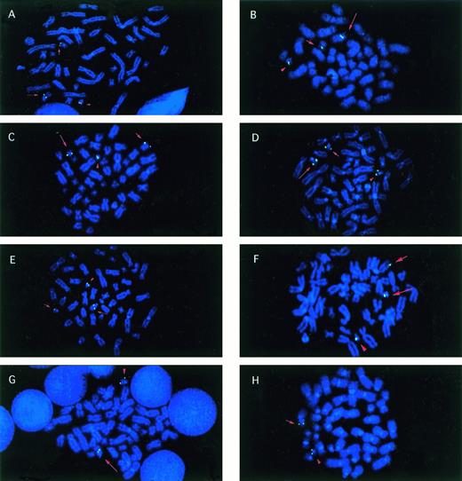 Fig. 3. Metaphase cells from patients with balanced reciprocal translocations involving CBFA2. Signals (green) fromCBFA2 probes that were split by the translocation are indicated on the der(21) (long arrow), the partner derivative (short arrow), and the normal 21 (arrowhead) chromosomes in all examples, except as noted. (A) Patient no. 1 with the t(17;21)(q11.2;q22) hybridized with the biotinylated clone wc-6. (B) Patient no. 2, t(5;21) with walking clone 7. (C) Patient no. 3, t(12;21) with wc-8. (D) Patient no. 5, t(15;21) with wc-5. (E) Patient no. 6, t(14;21) with AML21-telomeric cosmid contig. (F) Patient no. 7, t(1;21)(p36;q22) with wc-5. (G) Patient no. 4, t(17;21) with AML21-centromeric contig. The der(21) (long arrow) and normal 21 (arrowhead) were labeled. (H) Patient no. 4, t(17;21) with AML21-telomeric contig. The der(17) (short arrow) and normal 21 (arrowhead) were labeled.
