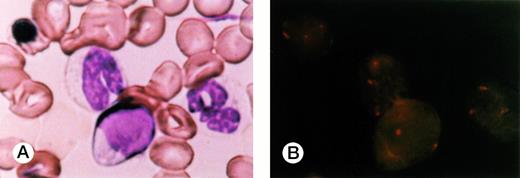 Fig. 2. FISH of BM smear of patient 1. (A) An erythroblast, two neutrophils, and lymphocytes in May-Grünwald-Giemsa stain. (B) FISH results applied to the smear. Three signals were recognized in the erythroblast and neutrophils but none in the lymphocytes.