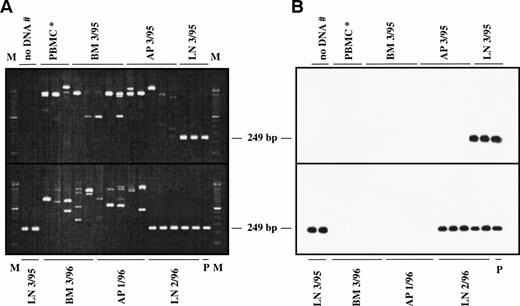 Fig. 4. Representative seminested PCR analysis of H-RS cell-specific DNA in apheresis material, bone marrow, spleen, and lymph node samples from a patient with NS-HD (patient no. 1; A and B) and a patient with MC-HD (patient no. 2; C and D). DNA samples (1 μg) were amplified in five replicates (except control PBMCs for patient no. 1) using NSfor and NSrev1/rev2 primers (patient no. 1) and MCfor and MCrev1/rev2 primers (patient no. 2). PCR products were fractionated by agarose gel electrophoresis (2%) and stained with ethidium bromide (A and C). After Southern blot, the DNA was hybridized to the internal FITC-labeled oligonucleotide NSintern (B) or MCintern (D) and visualized by ECL. M, 100-bp DNA ladder; P, PCR product amplified from single H-RS cells served as the positive controls (NSVH1, 249 bp; MCVH1, 142 bp). Negative controls: DNA from a healthy volunteer (PBMC*), water control after first and second (#) PCR.