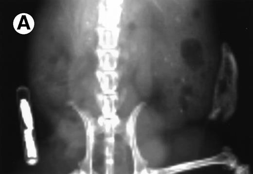 Fig. 7. Loss in density of human bone in myeloma-bearing SCID-hu mouse as seen by x-radiography. Human bones are visible in the right-hand side. The highly contrasted devices visible in the bottom left corner are implant transponders used to identify the mice. (A) Myeloma-bearing mouse (patient no. 6): (B) Age-matched control SCID-hu mouse.