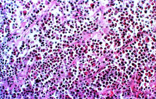 Fig. 2. Myeloma cell infiltrate in the human bone of a SCID-hu mouse. Photomicrograph of a 5-μm section of decalcified human bone recovered from SCID-hu mouse (patient no. 4). Hematoxylin and eosin staining, 10× objective.