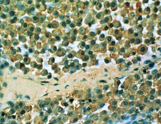 Fig. 3. cIg expression in the SCID-hu mouse. 20× objective photomicrograph of a 5-μm section of decalcified human bone recovered from SCID-hu mouse reacted with monoclonal antibody to human κ light chain (patient no. 4).