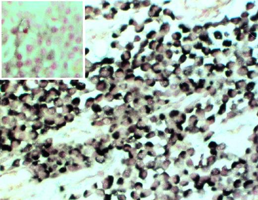 Fig. 4. Clonality of myeloma cells in the SCID-hu mouse. Decalcified human bone section was hybridized with patient-specific ASO (patient no. 4). (Insert) Control section hybridized with the ASO probe to the myeloma clone from patient no. 2. 20× objective.