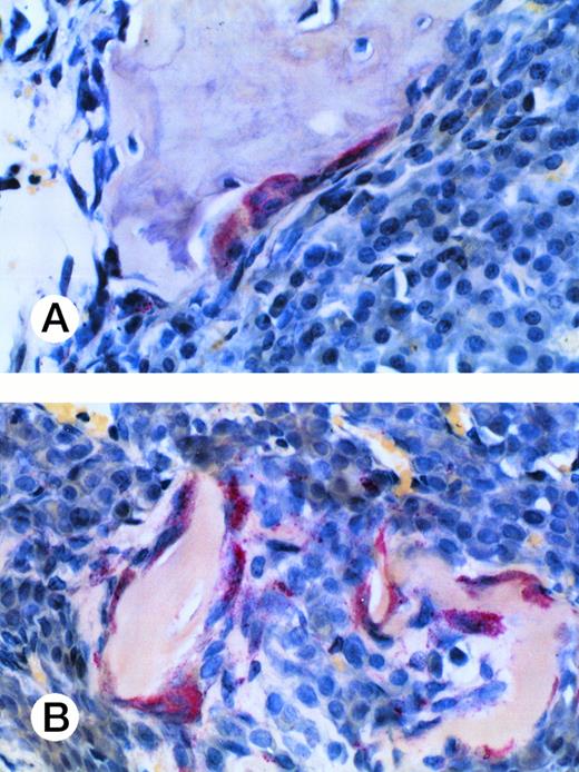 Fig. 6. Osteoclast activity in myeloma-bearing SCID-hu mouse. Photomicrograph of a TRAP-stained decalcified human bone section. Multinucleated osteoclasts (cells with red cytoplasm) surround and excavate cancellous (A) and trabecular (B) bone. Patient no. 4, 20× objective.