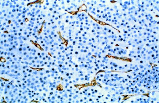 Fig. 8. Neo-vascularization in myeloma bearing SCID-hu mouse. Decalcified human bone sections immunostained with a mouse monoclonal antibody to human CD34. Proliferative endothelial cells are stained brown. Patient no. 4, 10× objective.
