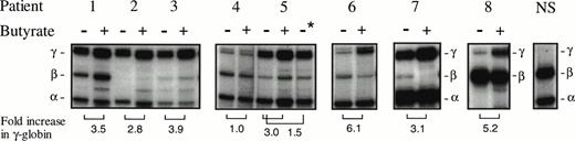Fig. 1. Analysis of globin mRNAs by primer extension in 7 patients with β-thalassemia (patients no. 1 through 7), 1 patient with sickle cell anemia (patient no. 8), and a normal adult subject (NS). Samples obtained before therapy and during therapy are designated with − and + above the lane, respectively. Patient no. 5 was analyzed before therapy was completed (−), 24 hours after therapy was completed (+), and 44 hours after therapy ended (−*). Fold increases of γ-globin over the subject’s baseline are shown at the bottom of the lanes. Patient no. 4 was the single subject studied in whom an increase in γ-globin mRNA was not observed.